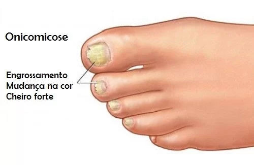 Tratamento Micose